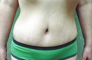 Abdominoplasty Procedure