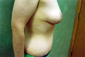 Abdominoplasty Procedure