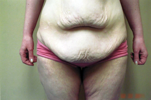 Abdominoplasty Procedure