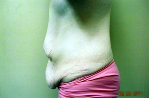 Abdominoplasty Procedure
