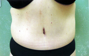 Abdominoplasty Procedure