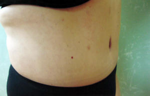 Abdominoplasty Procedure