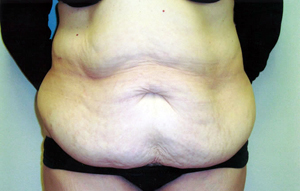 Abdominoplasty Procedure