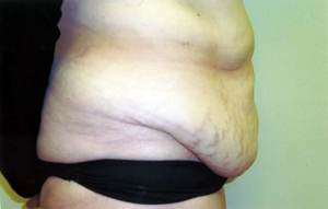 Abdominoplasty Procedure