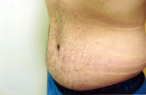 Abdominoplasty Procedure