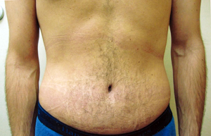 Abdominoplasty Procedure