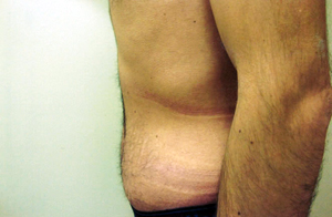 Abdominoplasty Procedure