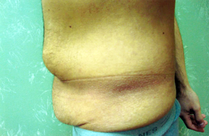 Abdominoplasty Procedure