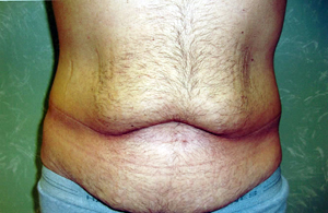 Abdominoplasty Procedure