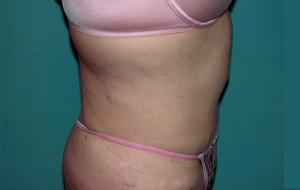 Abdominoplasty Procedure