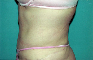 Abdominoplasty Procedure