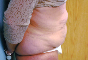 Abdominoplasty Procedure