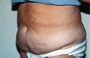 Abdominoplasty Procedure