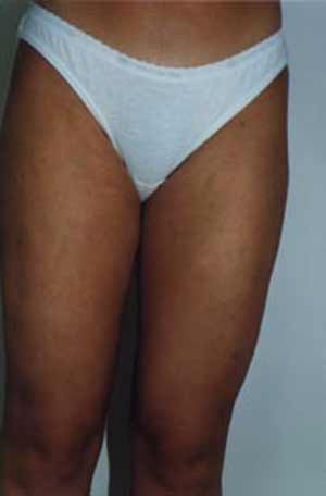 Liposuction