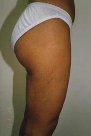 Liposuction