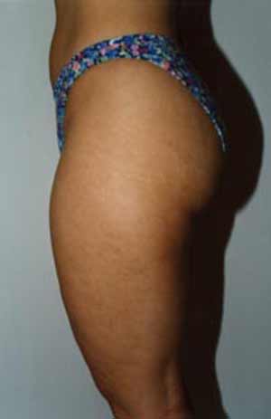 Liposuction