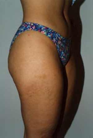Liposuction