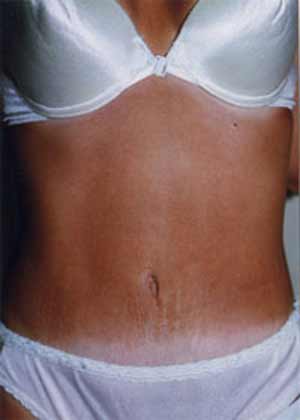 Liposuction
