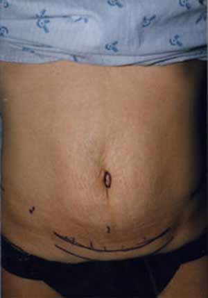 Liposuction