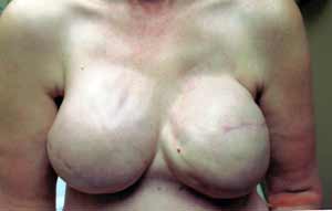 Breast Reconstruction