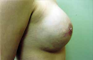 Breast Reconstruction