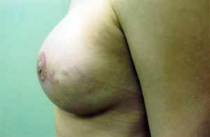 Breast Reconstruction