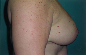 Breast reduction post treatment photo